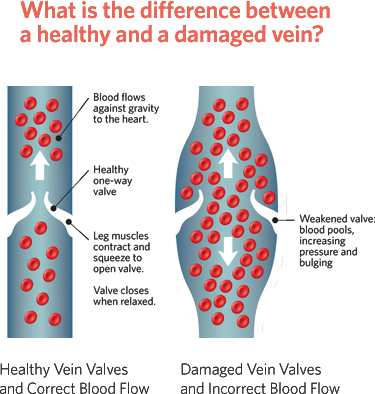 Difference between healthy and damaged veins