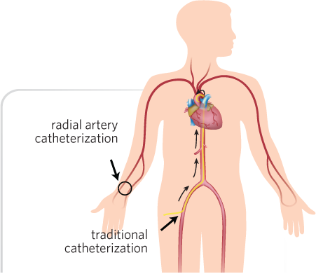 Catheterization Lab Procedures